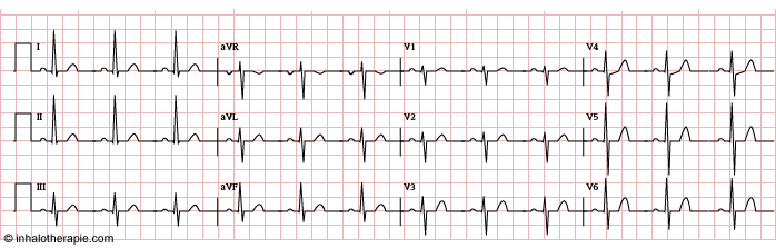 Électrocardiogramme standard